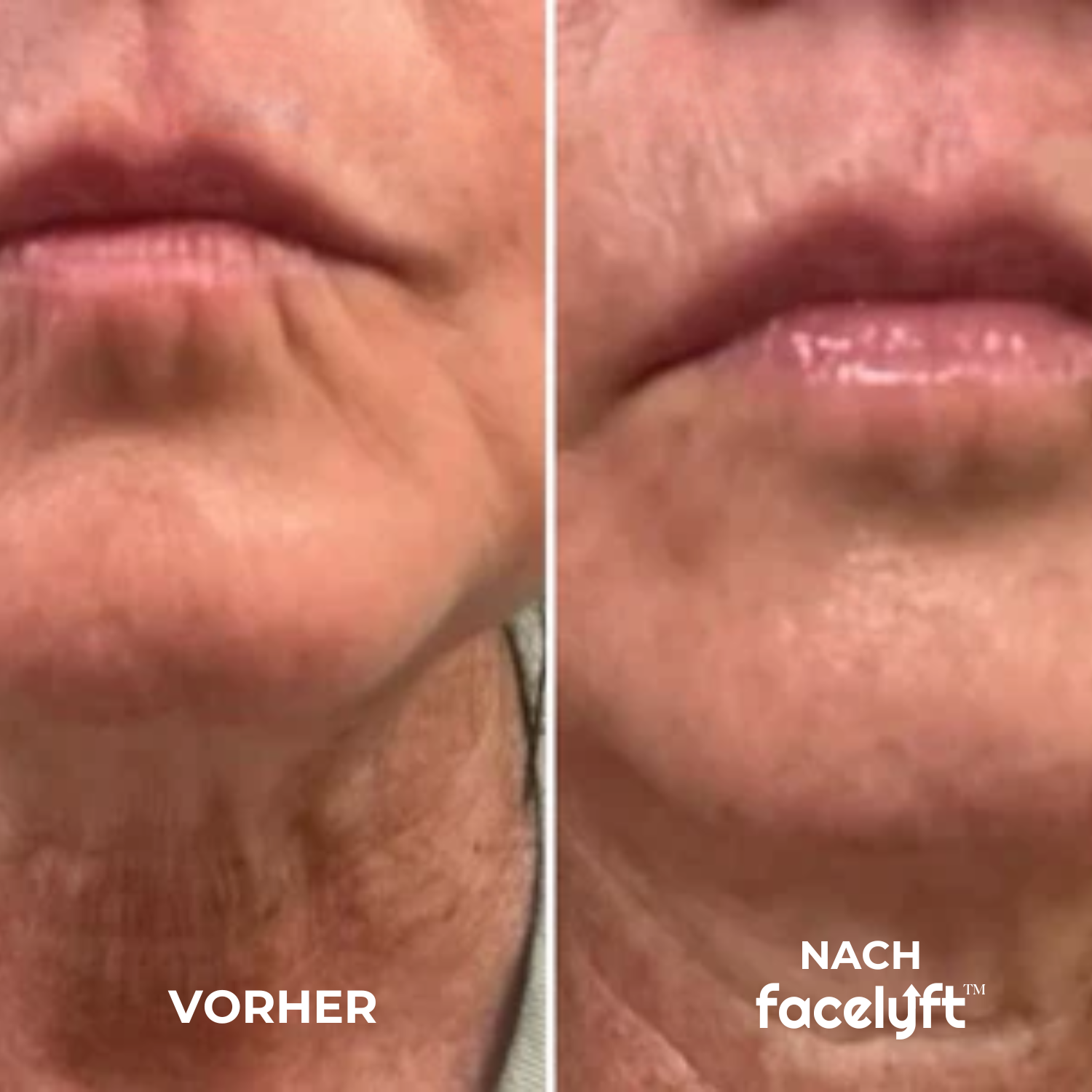 The Ritual | Sofort Lifting