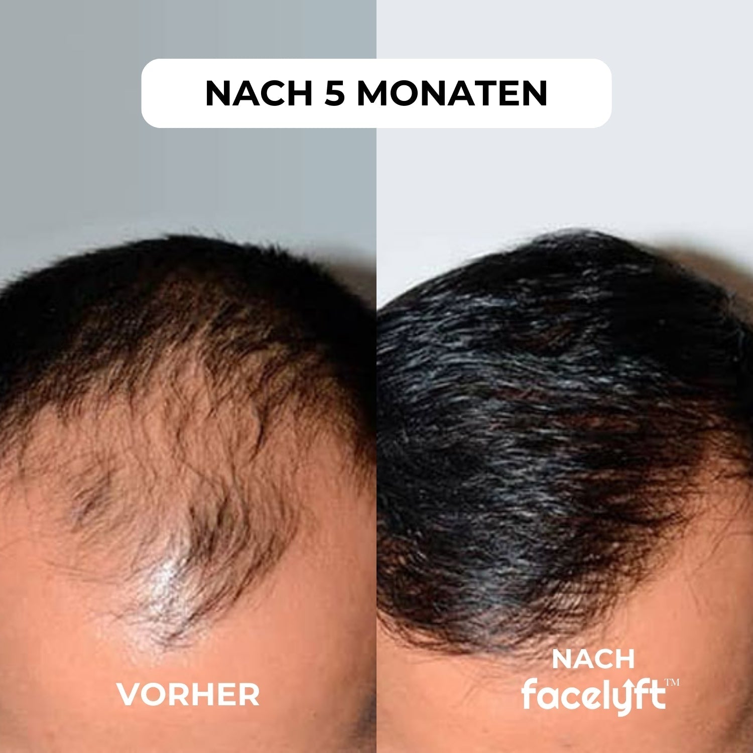 facelyft™ Men's Hairfusion