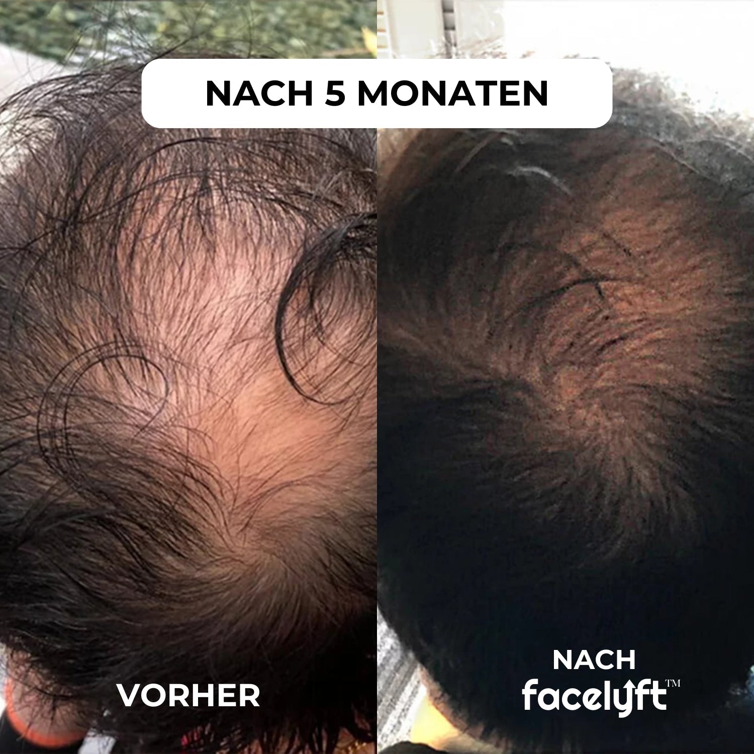 facelyft™ Men's Hairfusion