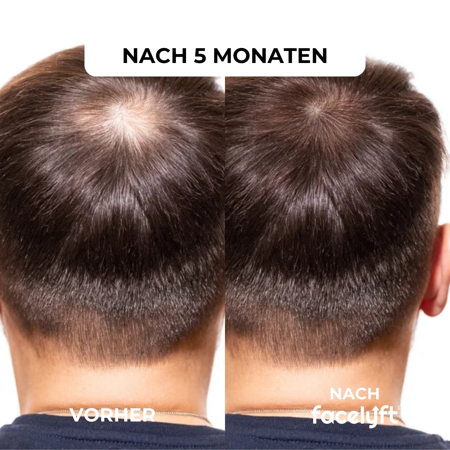 facelyft™ Men's Hairfusion