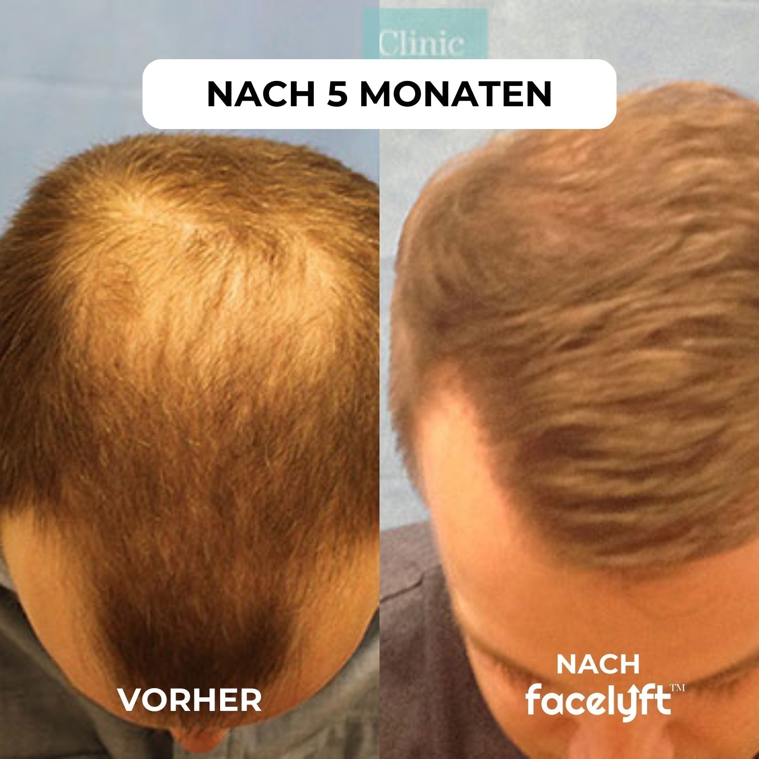 facelyft™ Men's Hairfusion