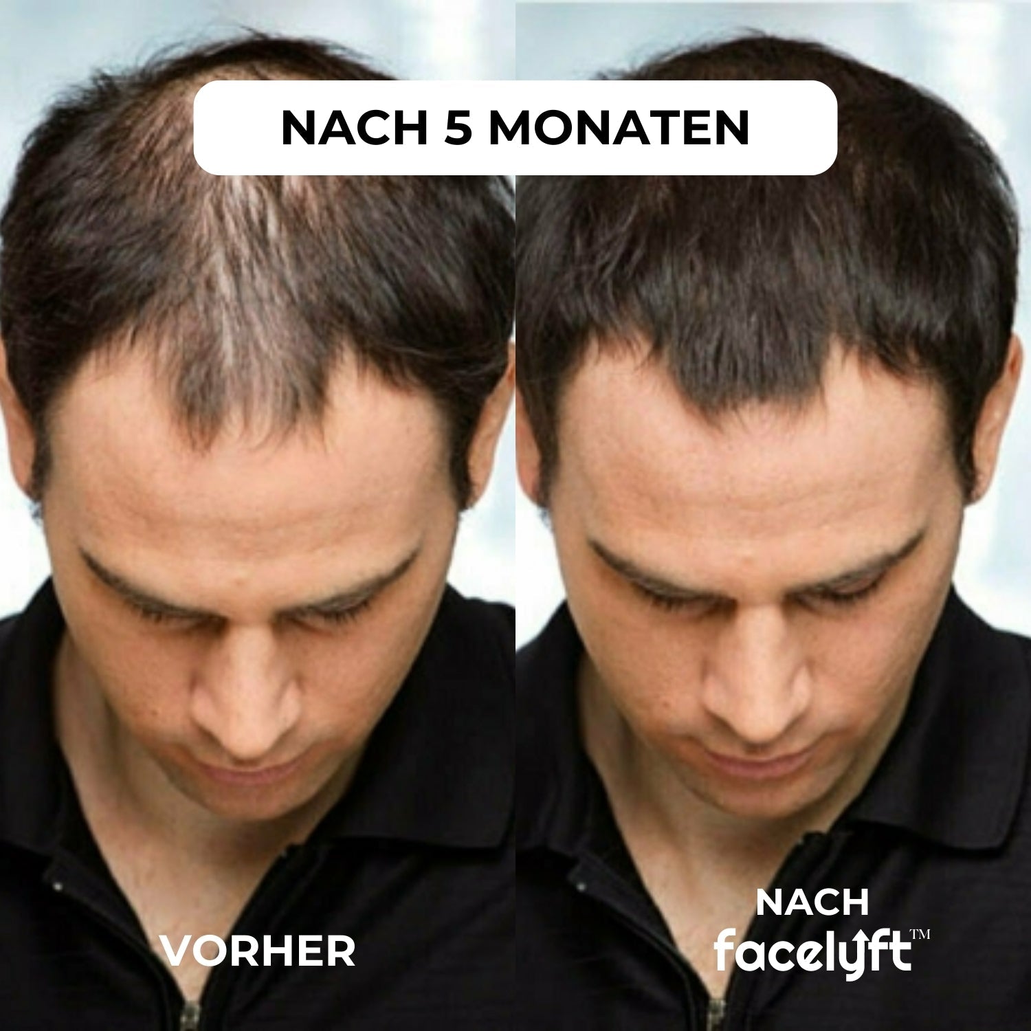 facelyft™ Men's Hairfusion