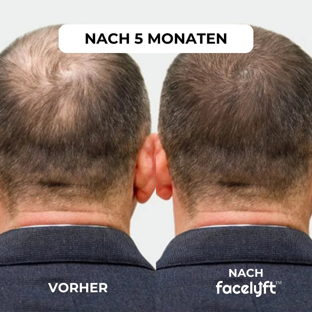 facelyft™ Men's Hairfusion