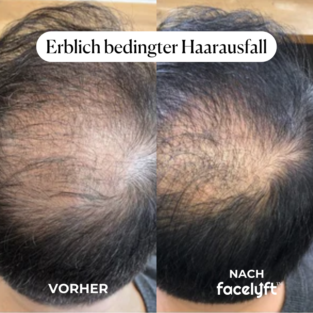 facelyft™ Men's Hairfusion