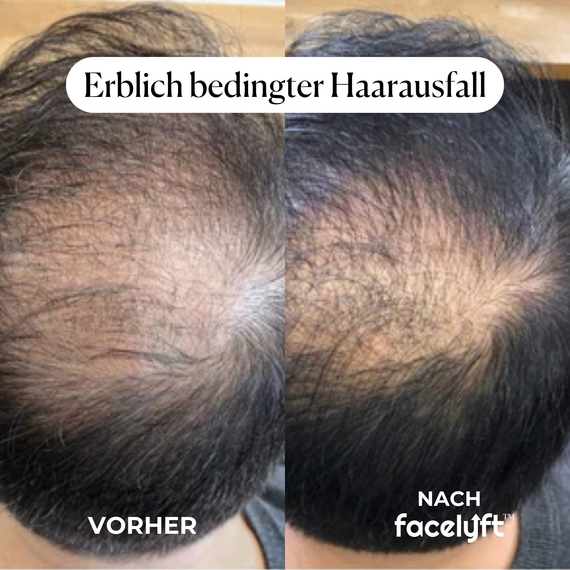 facelyft™ Men's Hairfusion