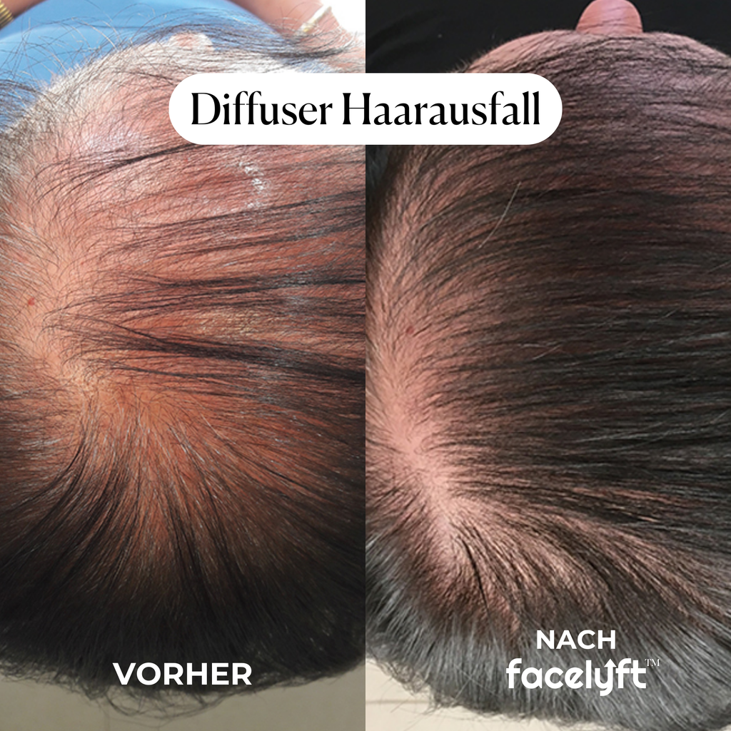 facelyft™ Men's Hairfusion
