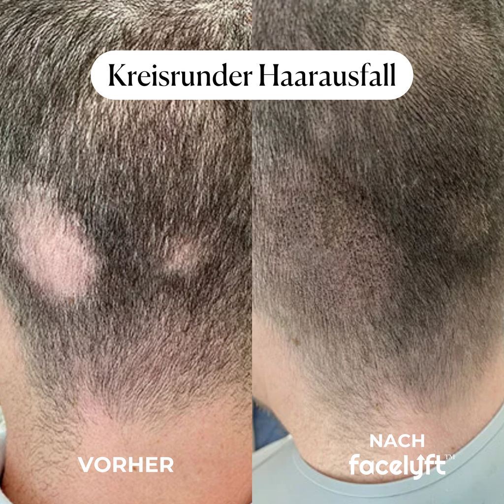 facelyft™ Men's Hairfusion