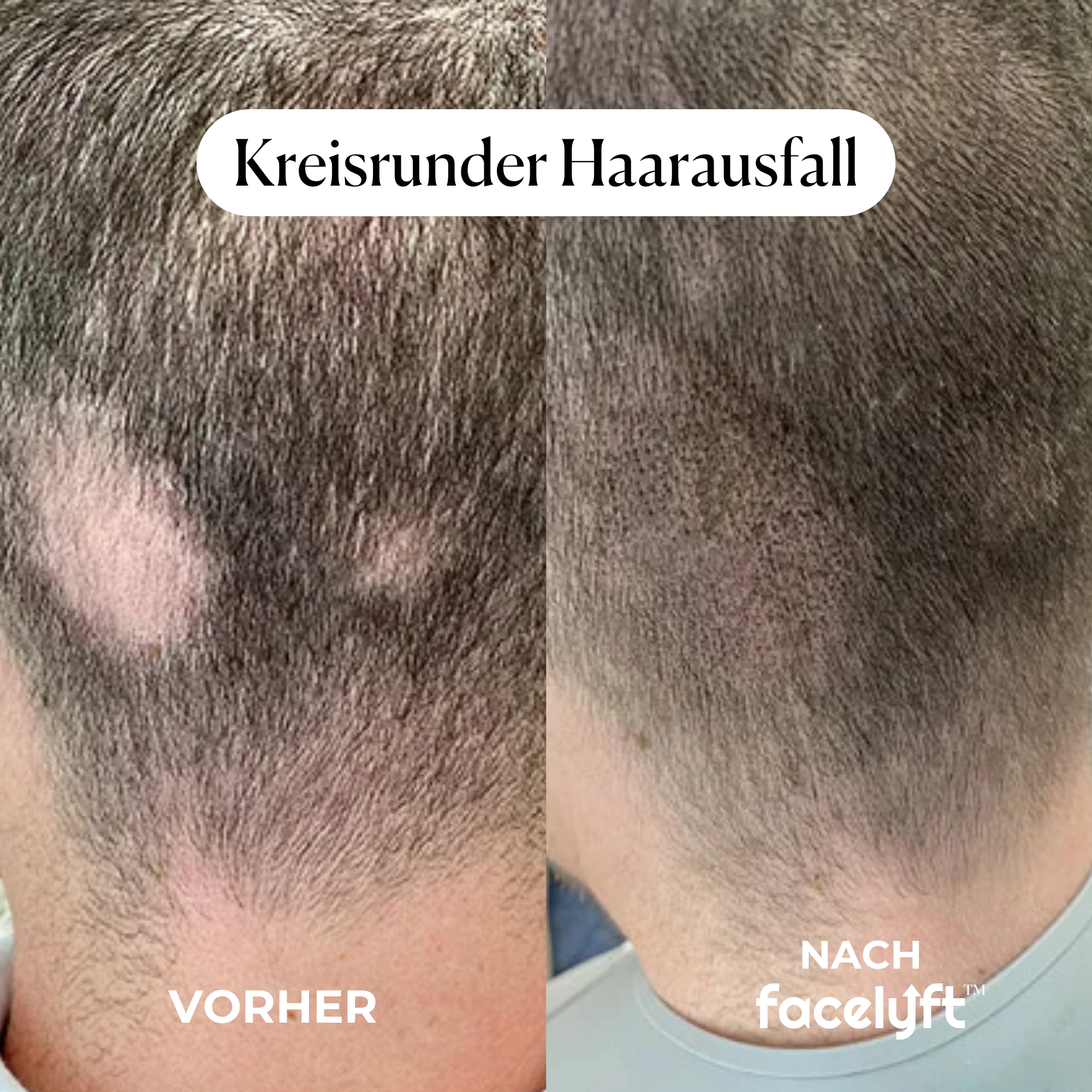 facelyft™ Men's Hairfusion