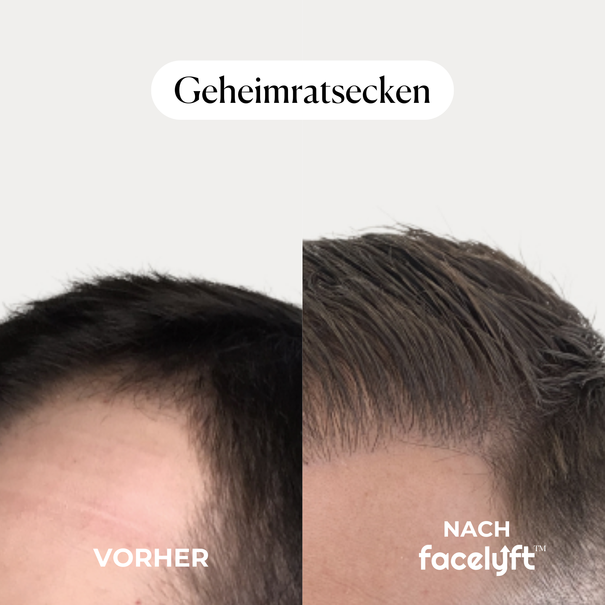 facelyft™ Men's Hairfusion