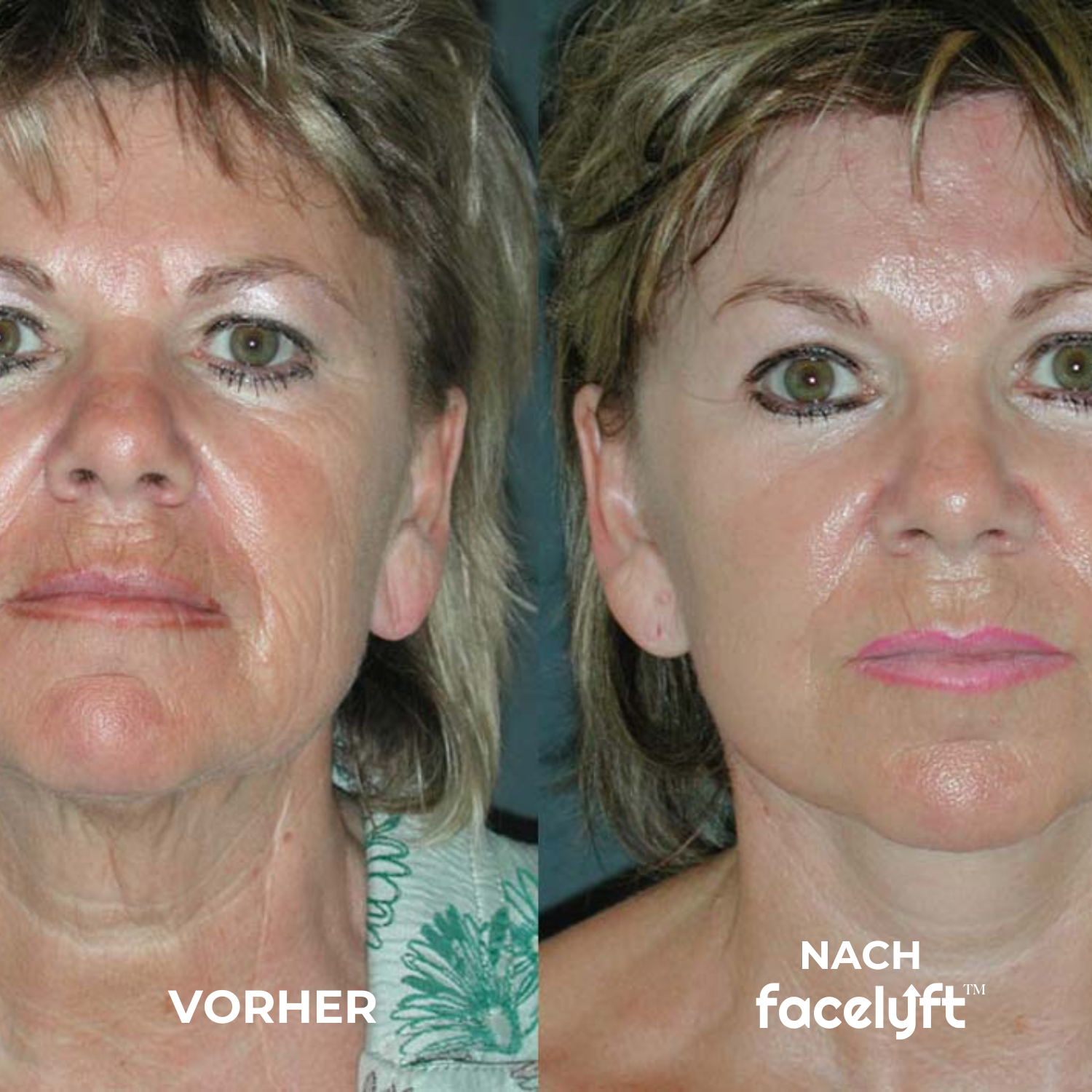 The Ritual | Sofort Lifting