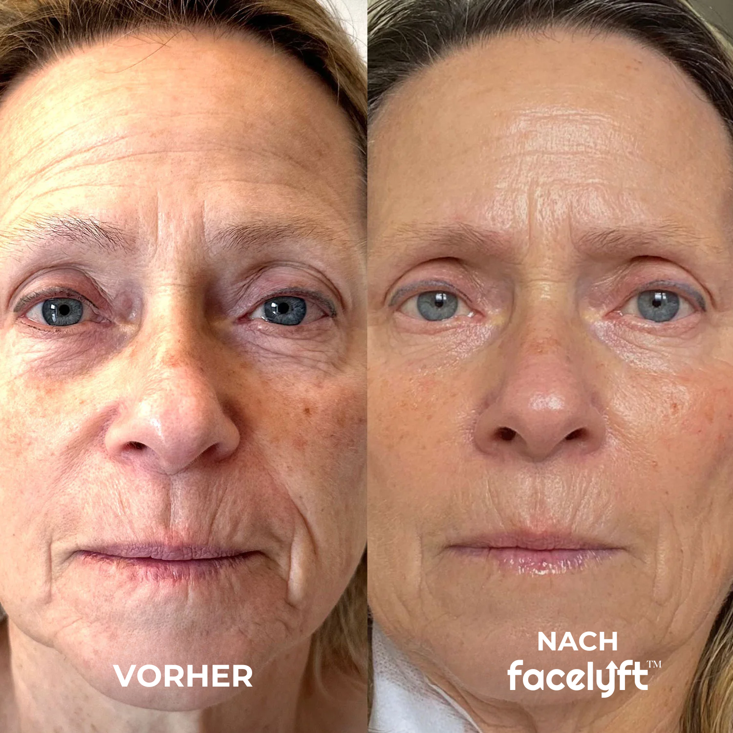 The Ritual | Sofort Lifting